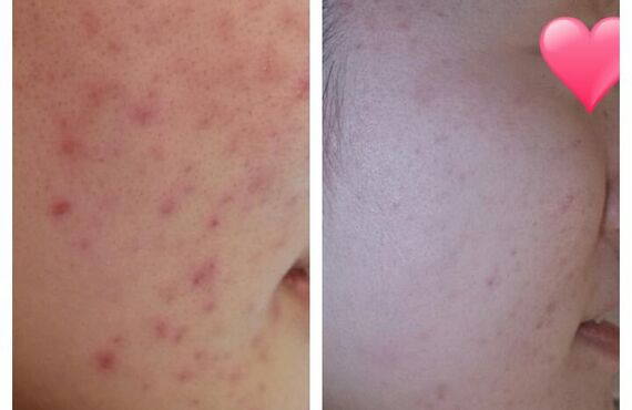 乾燥肌の改善は大宮エステサロンGLANDBEAUTY