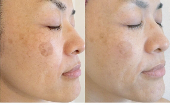 秋の肌トラブルは大宮エステサロンGLANDBEAUTYへ