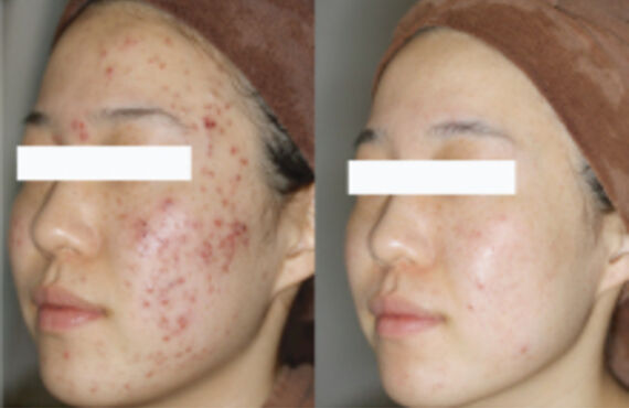 乾燥肌の改善は大宮エステサロンGLANDBEAUTY