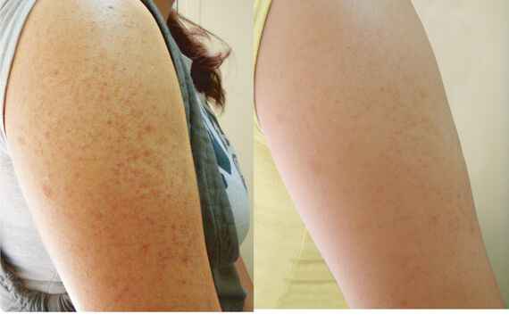 毛孔性苔癬治療は大宮エステサロンGLANDBEAUTY