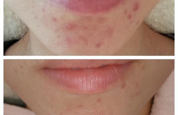 マスクによる肌荒れは大宮エステサロンGLANDBEAUTY