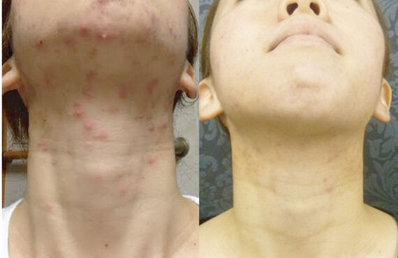 肌荒れ改善は大宮エステサロンGLANDBEAUTYへ